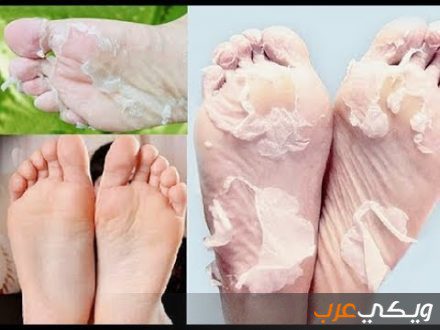 Utiliser de la levure alimentaire pour traiter les pieds gercés